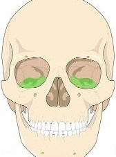 Fracture du plancher orbital pour Maubleu